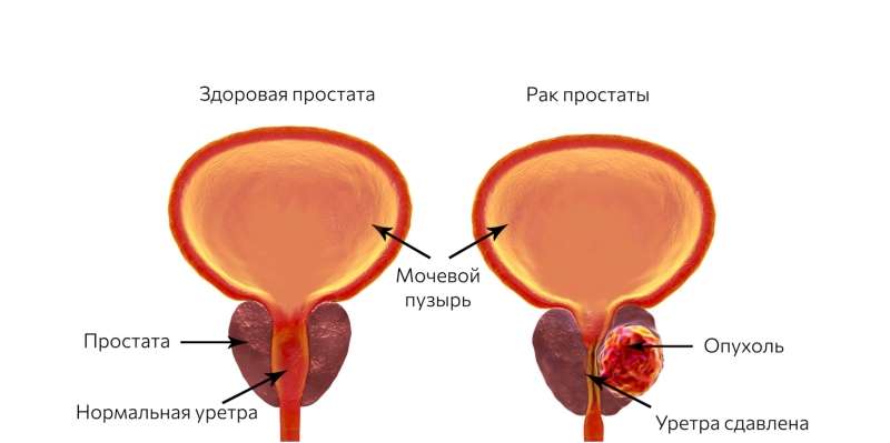 Что такое рак простаты и как его лечить